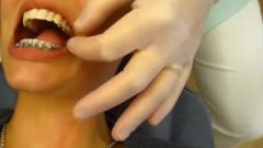 Insanely Spicy Whore Getting Braces Removed And Retainer Fitted