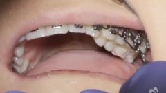 Changing An Arch Of A Magnificent Metal Mouth
