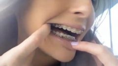 Showing Uvula While Showing Metal Mouth 1