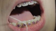 Gorgeous Mouth Cleaning With Metal Mouth